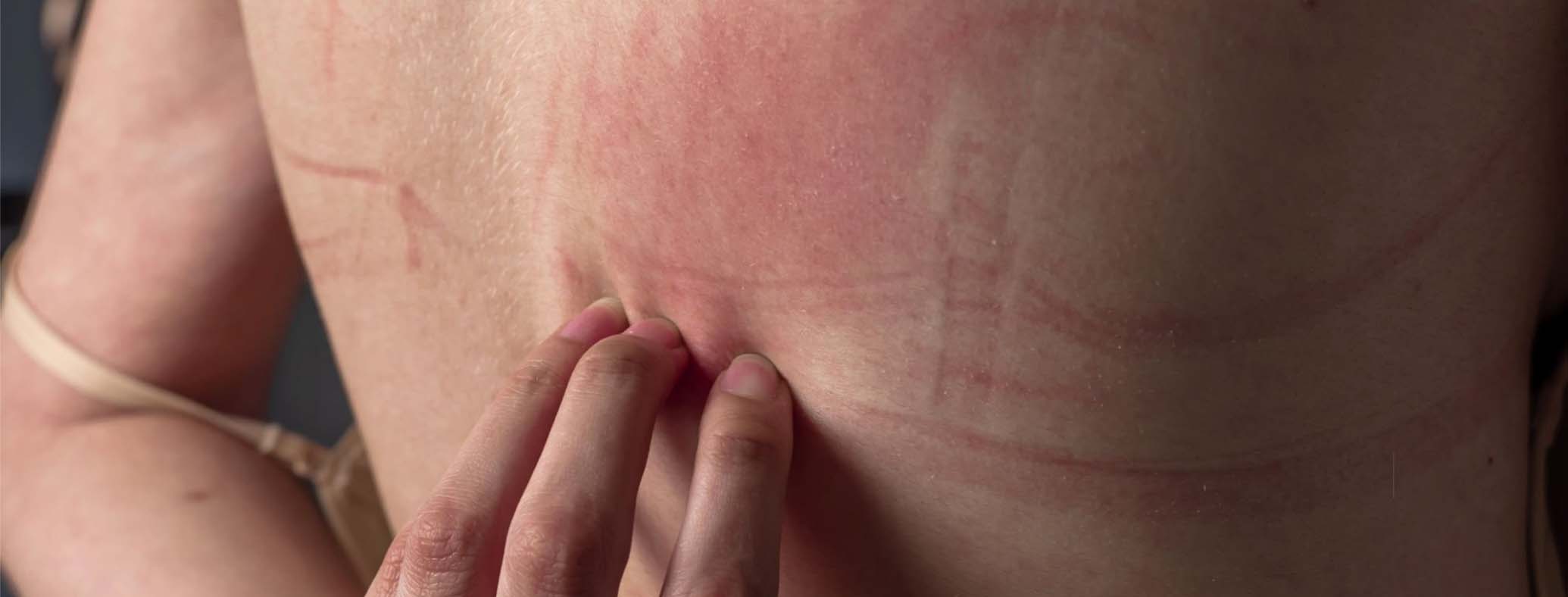 ব্রা ব্যবহারের কারণে ত্বকে র‍্যাশ